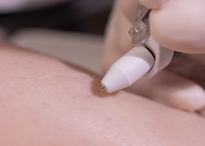 white hair removal treatment in Delhi